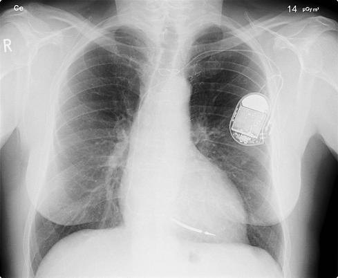 Hackers Outsmart Pacemakers, Fitbits: Worried Yet?